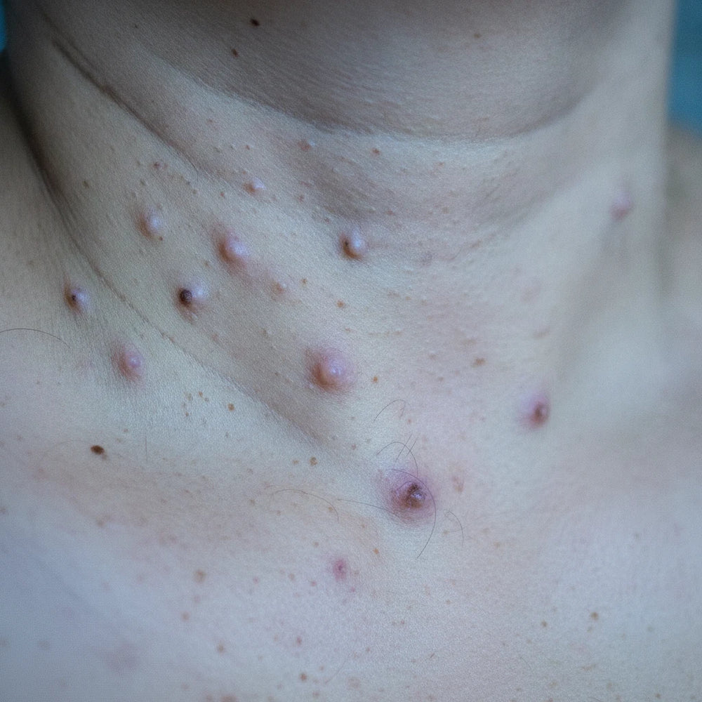 florama-apiclear-spray-veneno-abeja-quita-verrugas-antes.webp