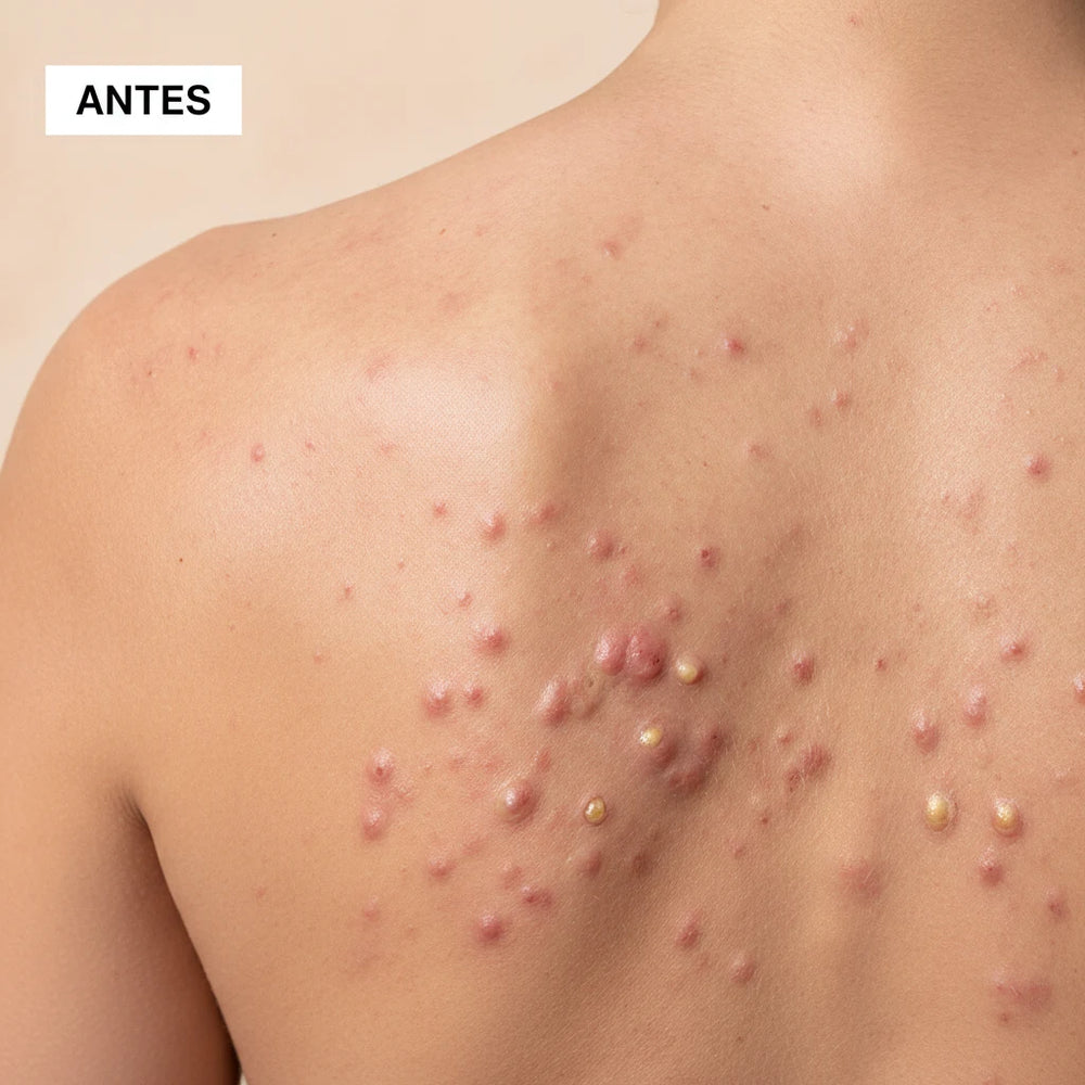 florama-gel-para-el-acne-quarxery-antes.webp